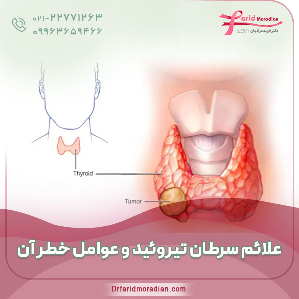 علائم سرطان تیروئید و عوامل خطر آن